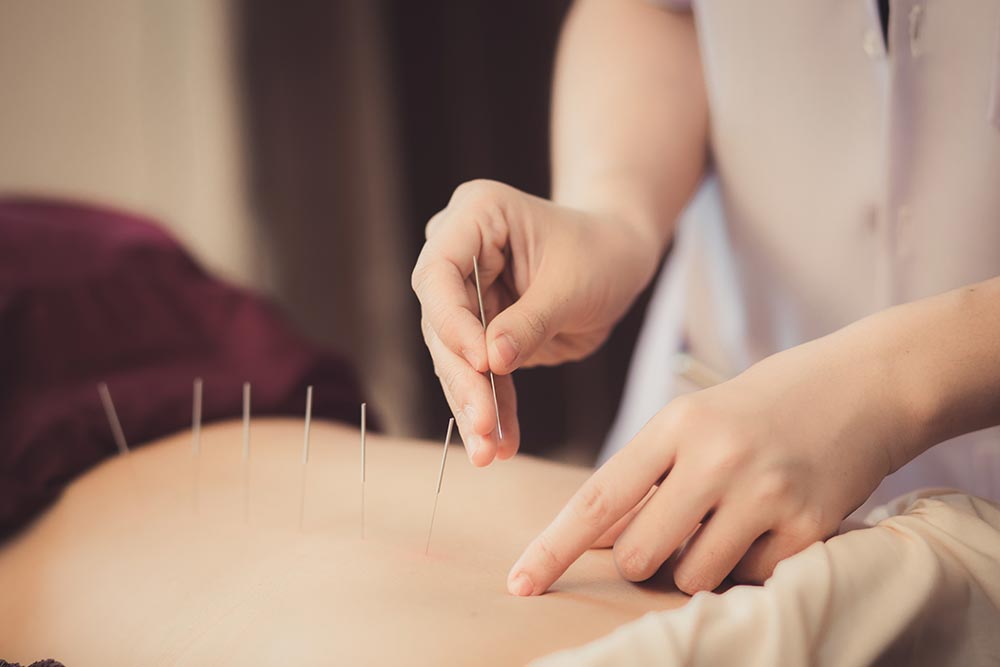 Dry needling at Blue Sky Physiotherapy is one of many treatment types we use to repair stiff or sore backs.